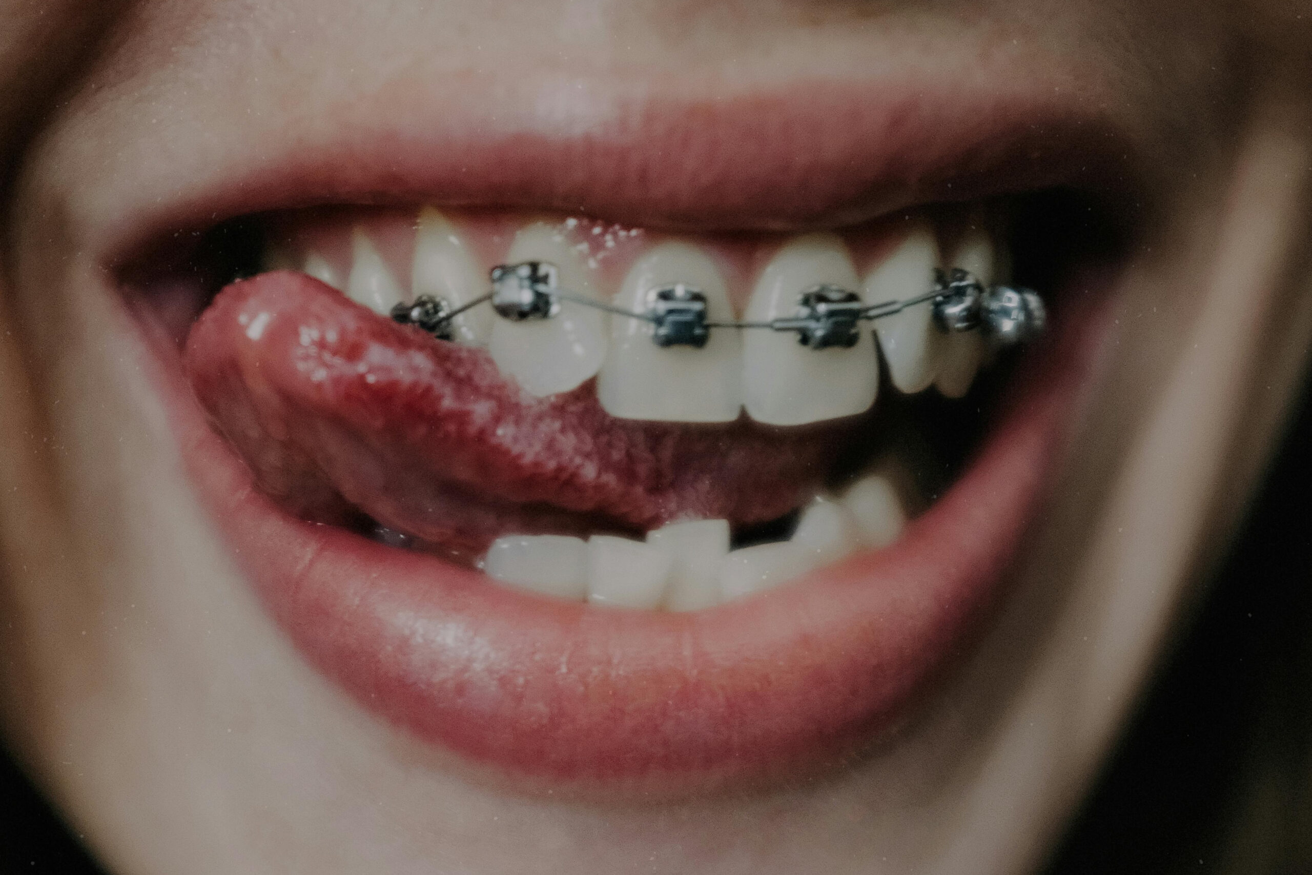 How Much Do Braces Cost in Singapore? A Detailed Breakdown