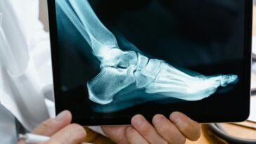 Alt: person showing x-ray image of foot, courtesy of Pexels